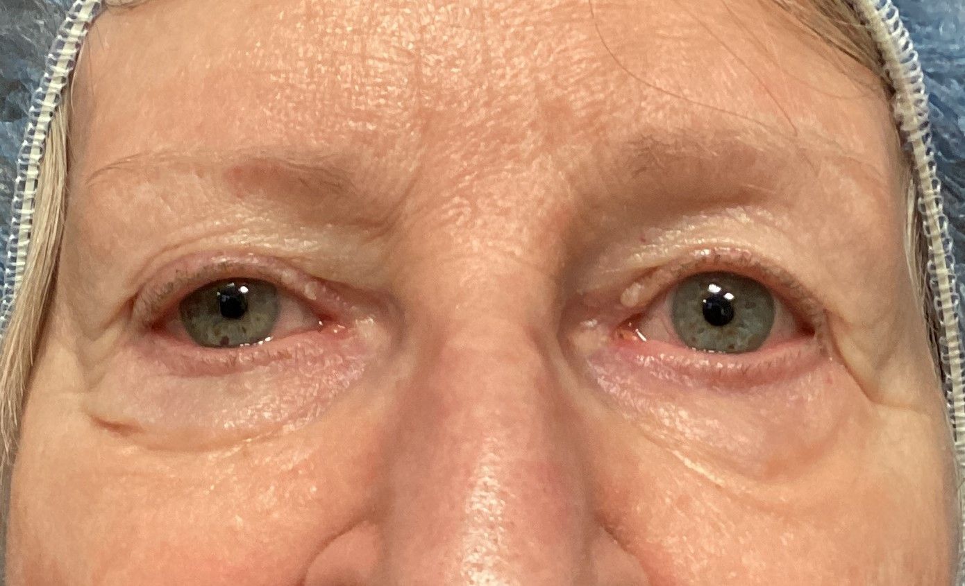 Chirurgie des 4 paupières