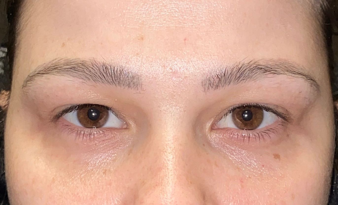 Chirurgie des paupieres inferieures