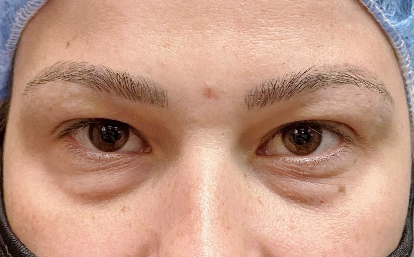 Chirurgie des paupieres inferieures