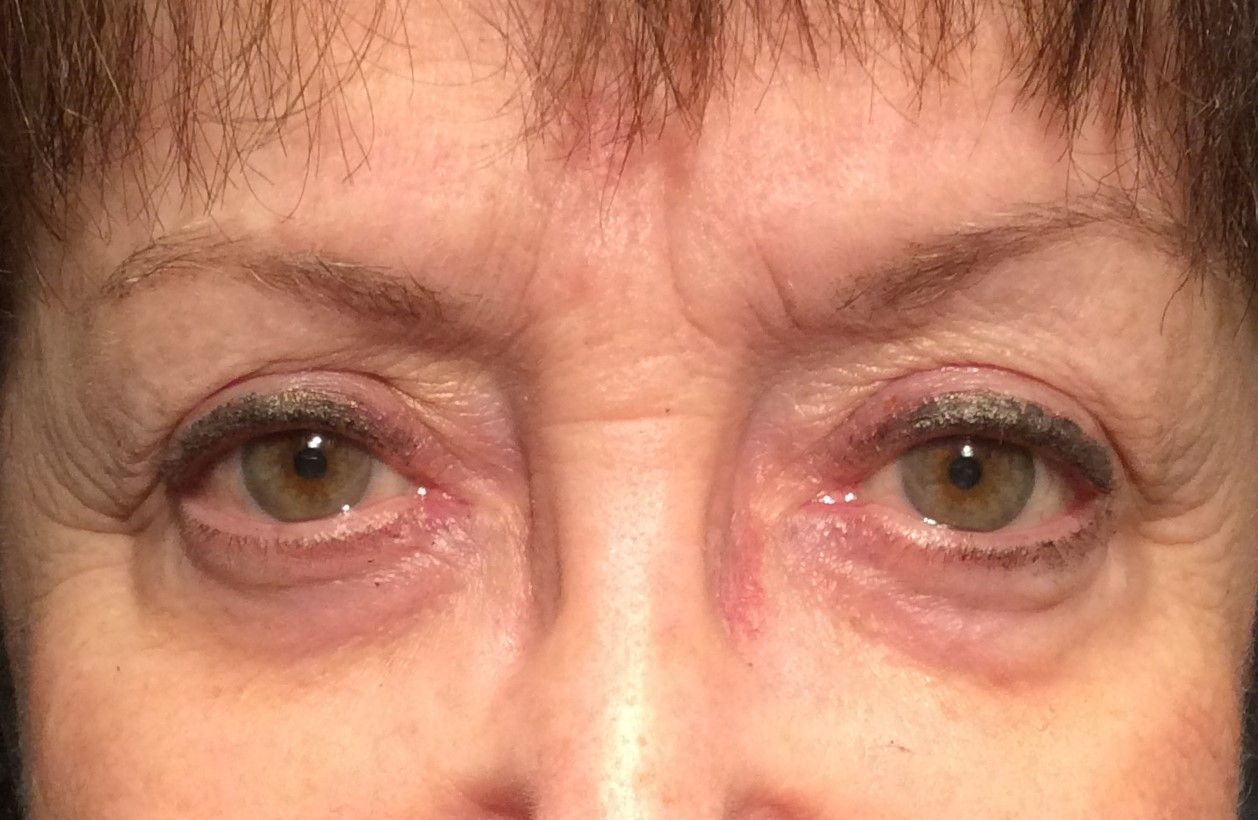 Chirurgie des paupieres inferieures