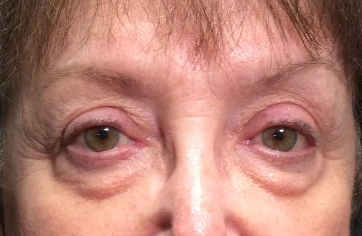 Chirurgie des paupieres inferieures