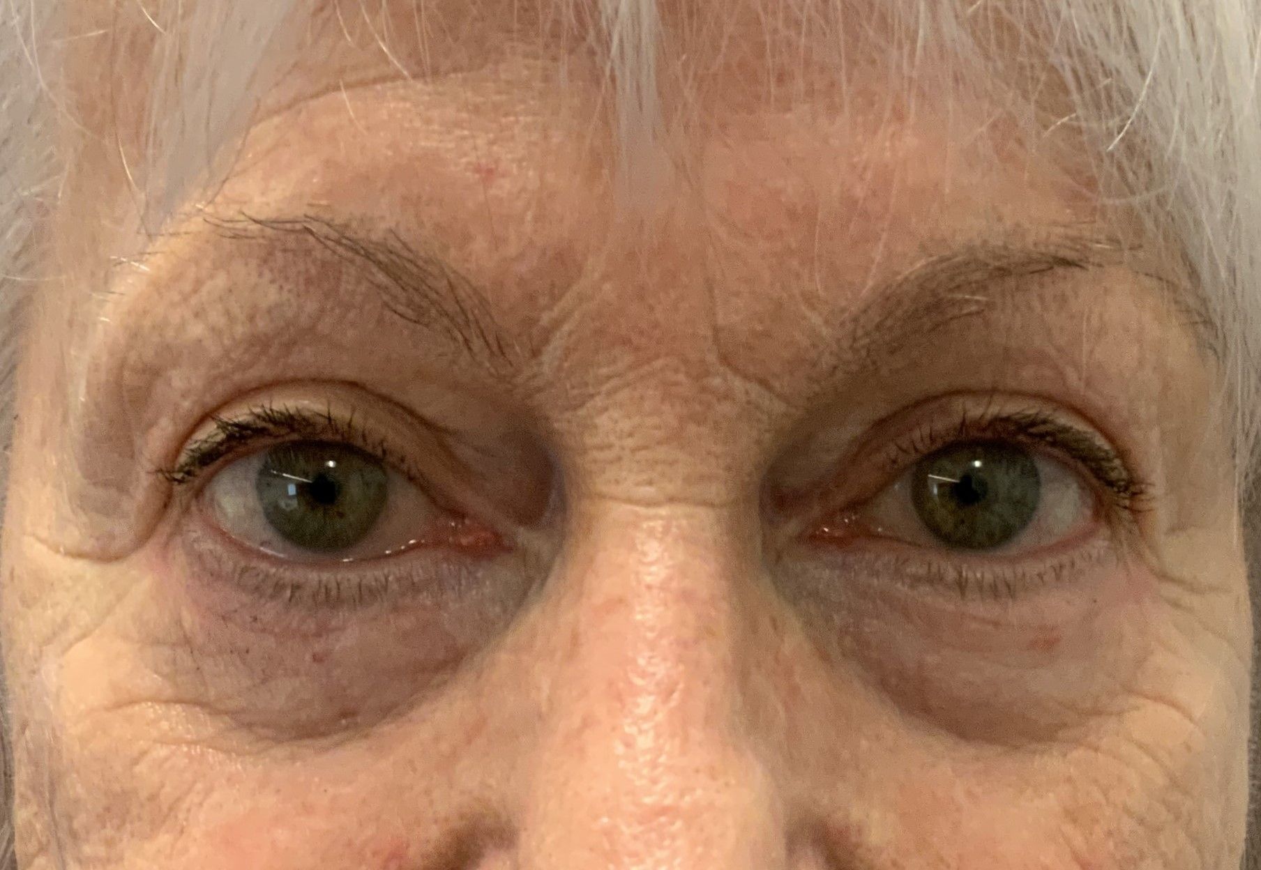 Chirurgie des 4 paupières