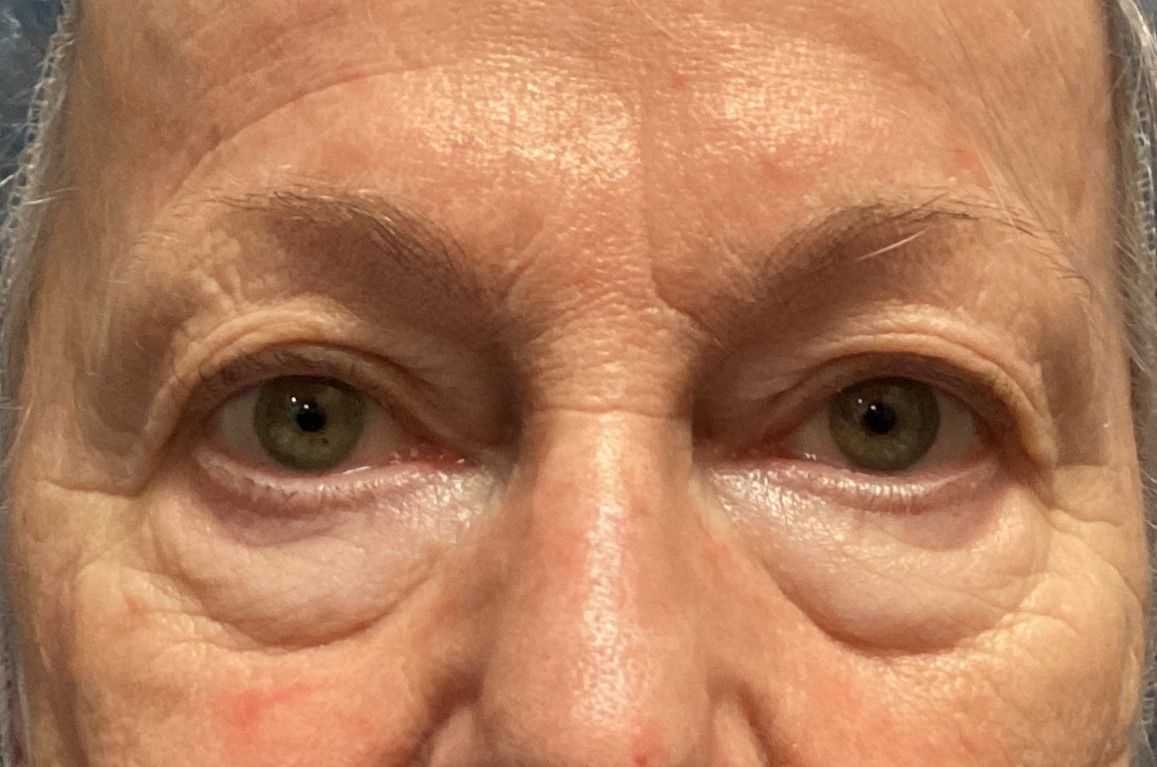 Chirurgie des 4 paupières