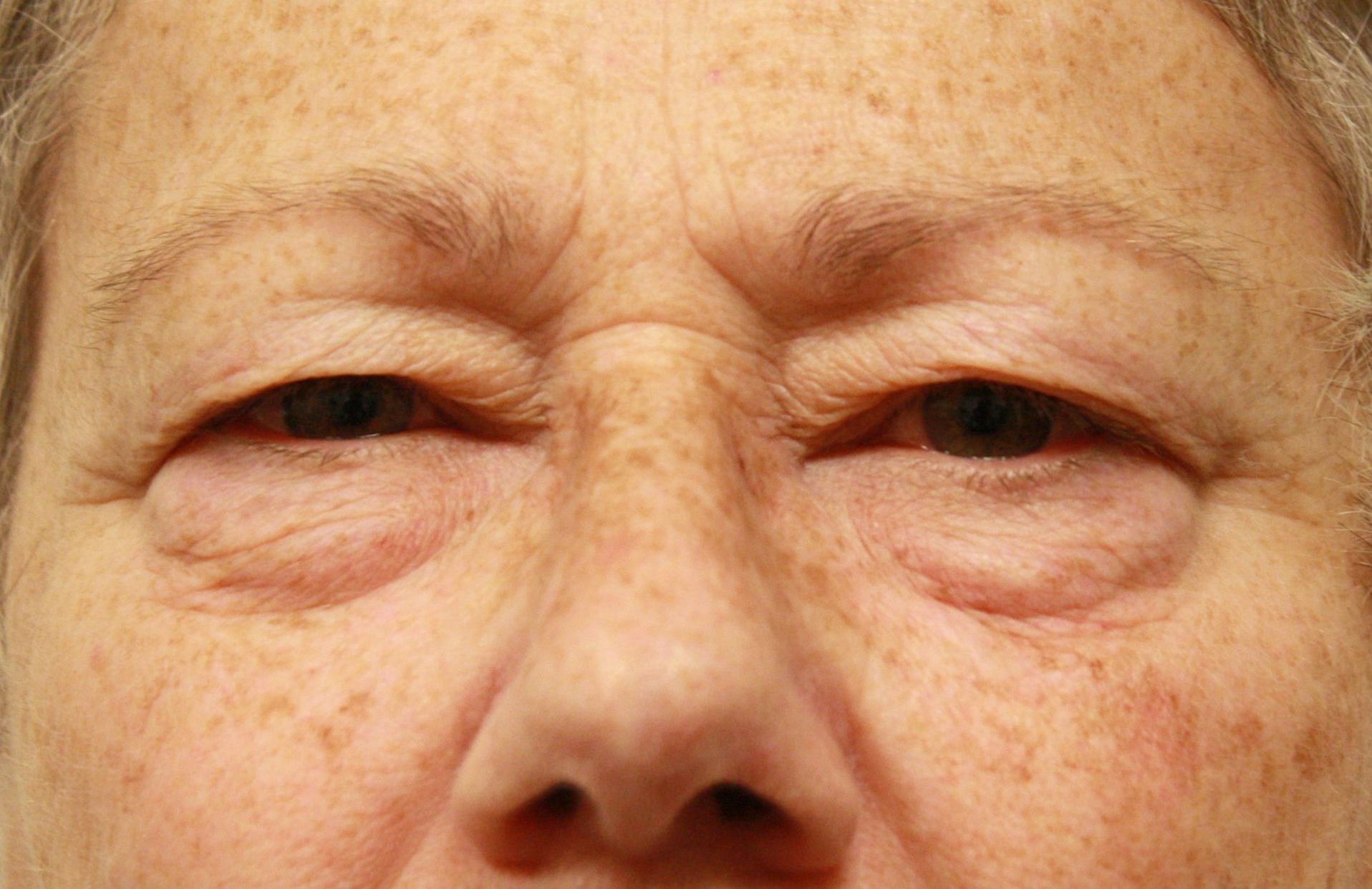 Chirurgie des 4 paupières