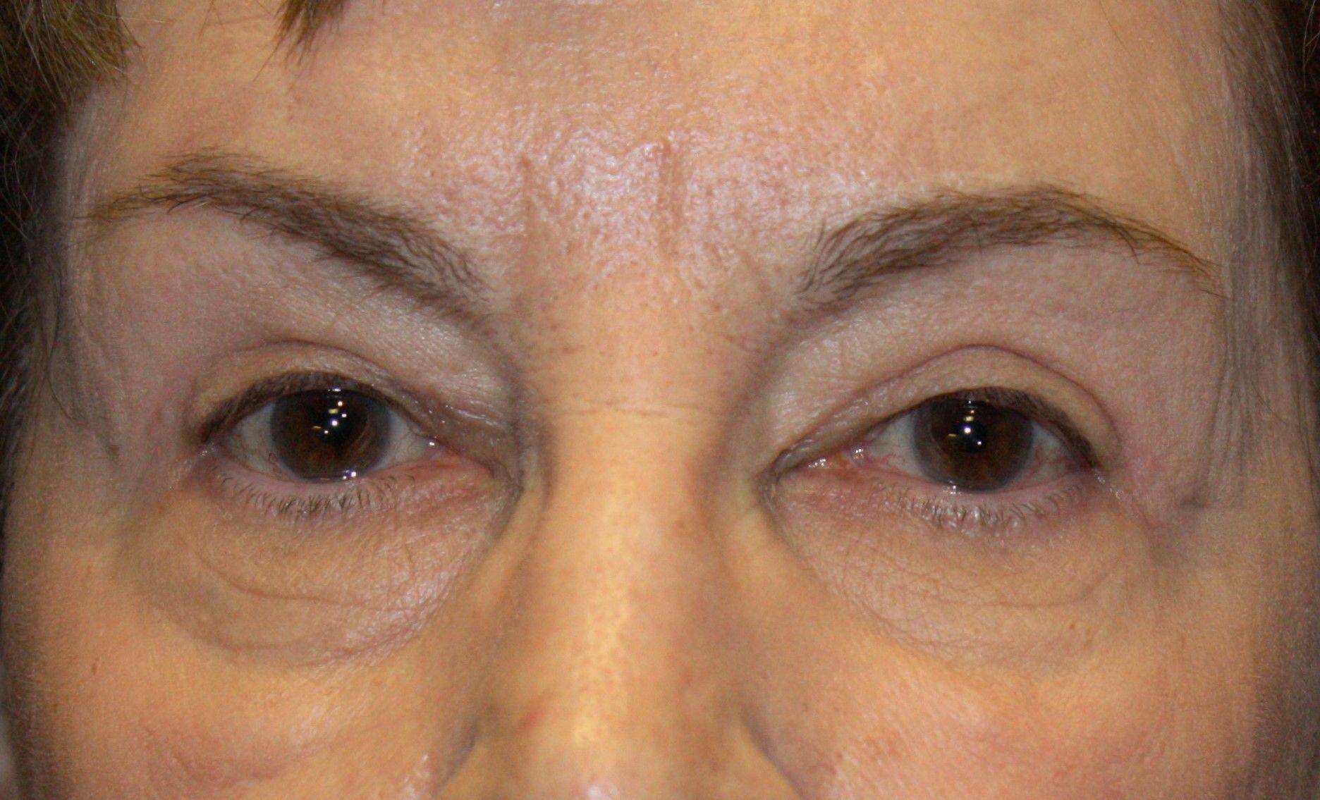 Chirurgie des paupières supérieures