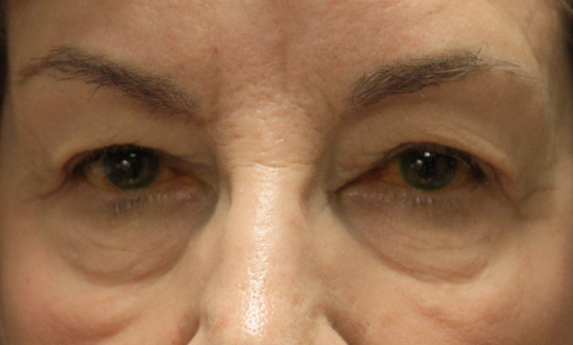 Chirurgie des paupières supérieures