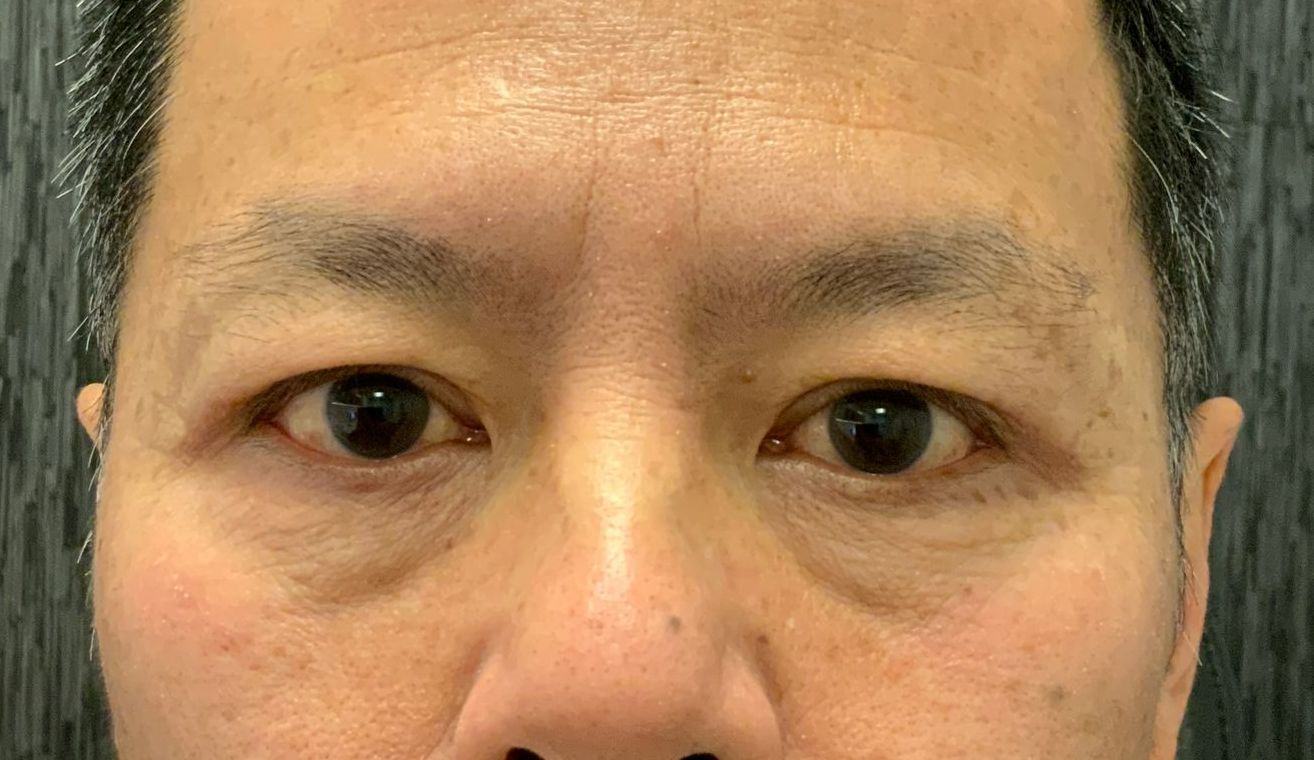 Chirurgie des paupieres asiatiques