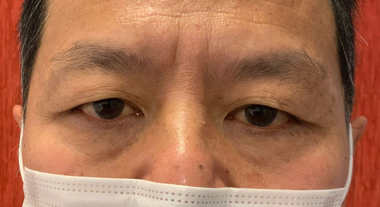 Chirurgie des paupieres asiatiques