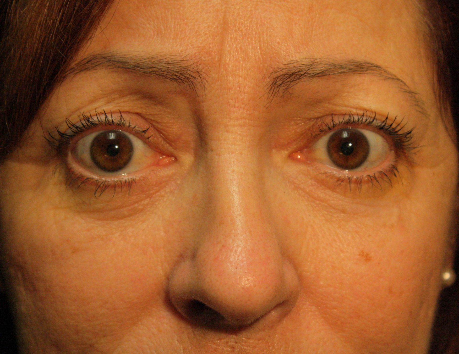 Chirurgie des paupieres inferieures