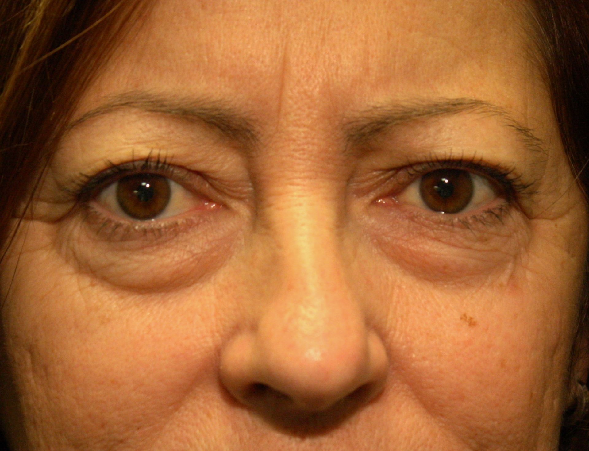 Chirurgie des paupieres inferieures