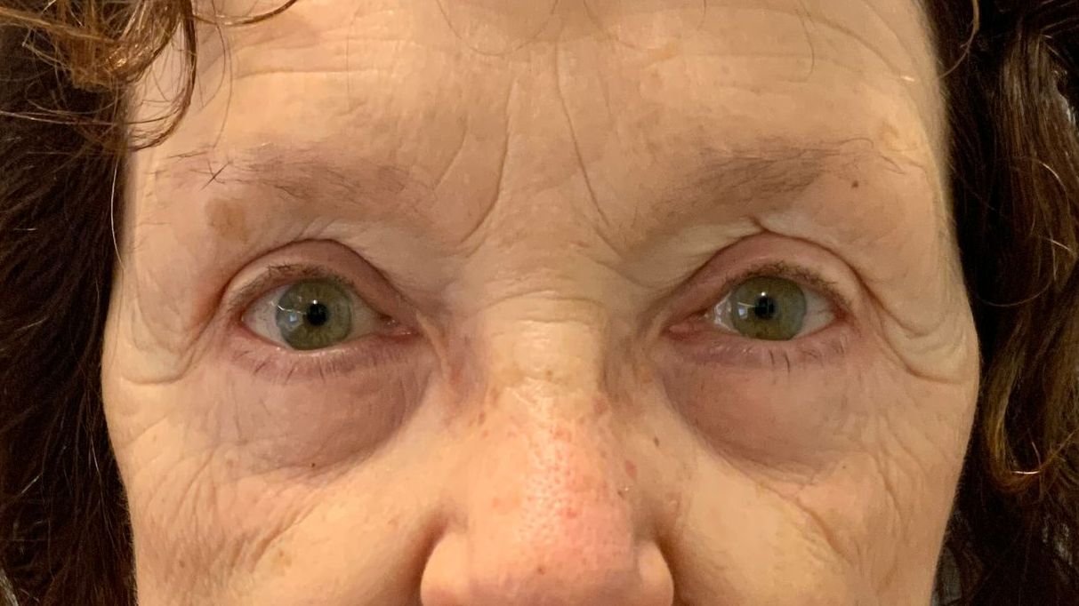 Chirurgie des 4 paupières