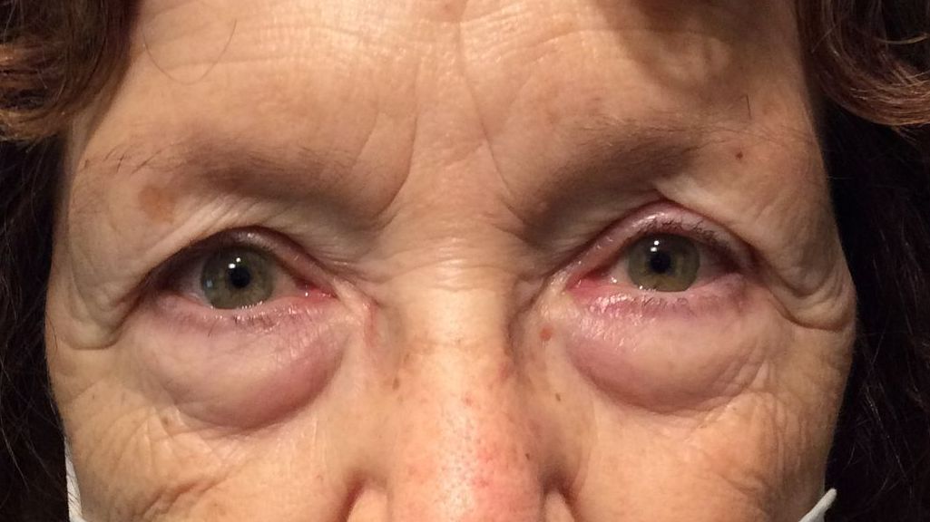 Chirurgie des 4 paupières