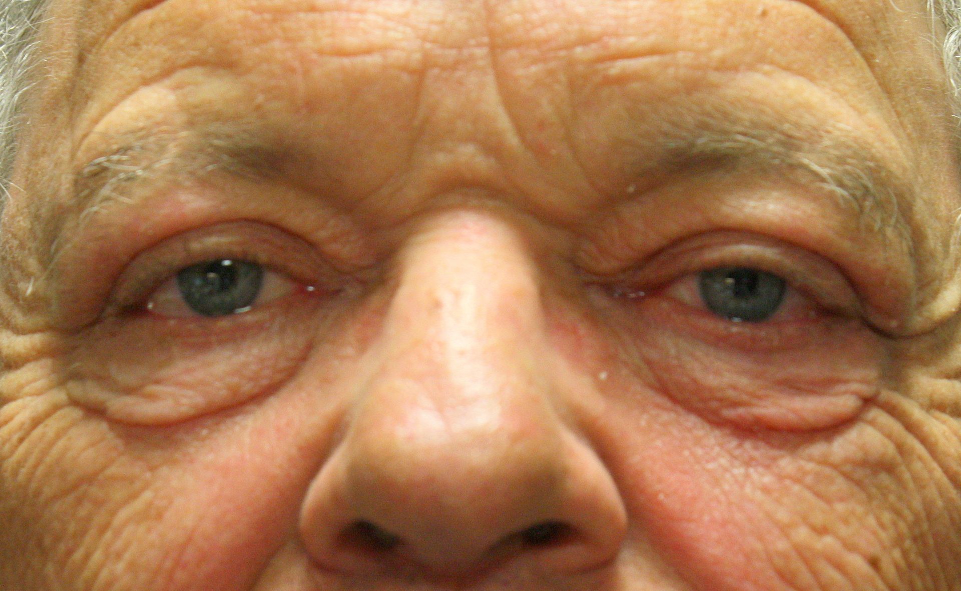 Chirurgie des 4 paupières