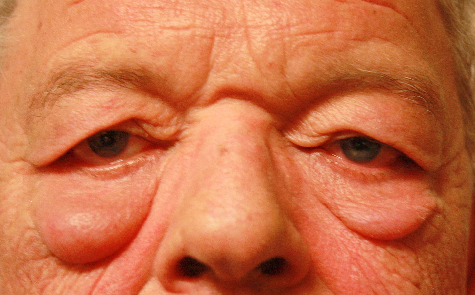 Chirurgie des 4 paupières