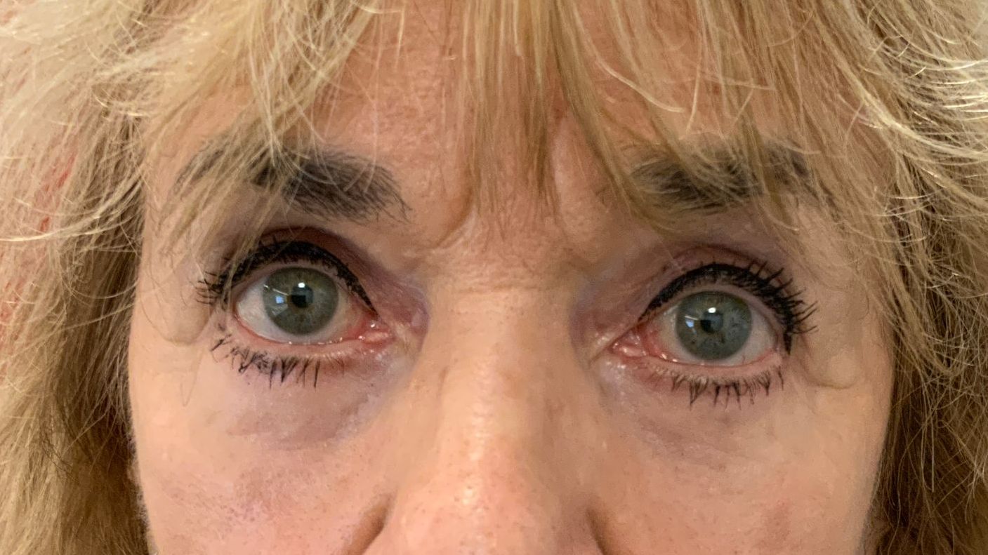 Chirurgie des 4 paupières