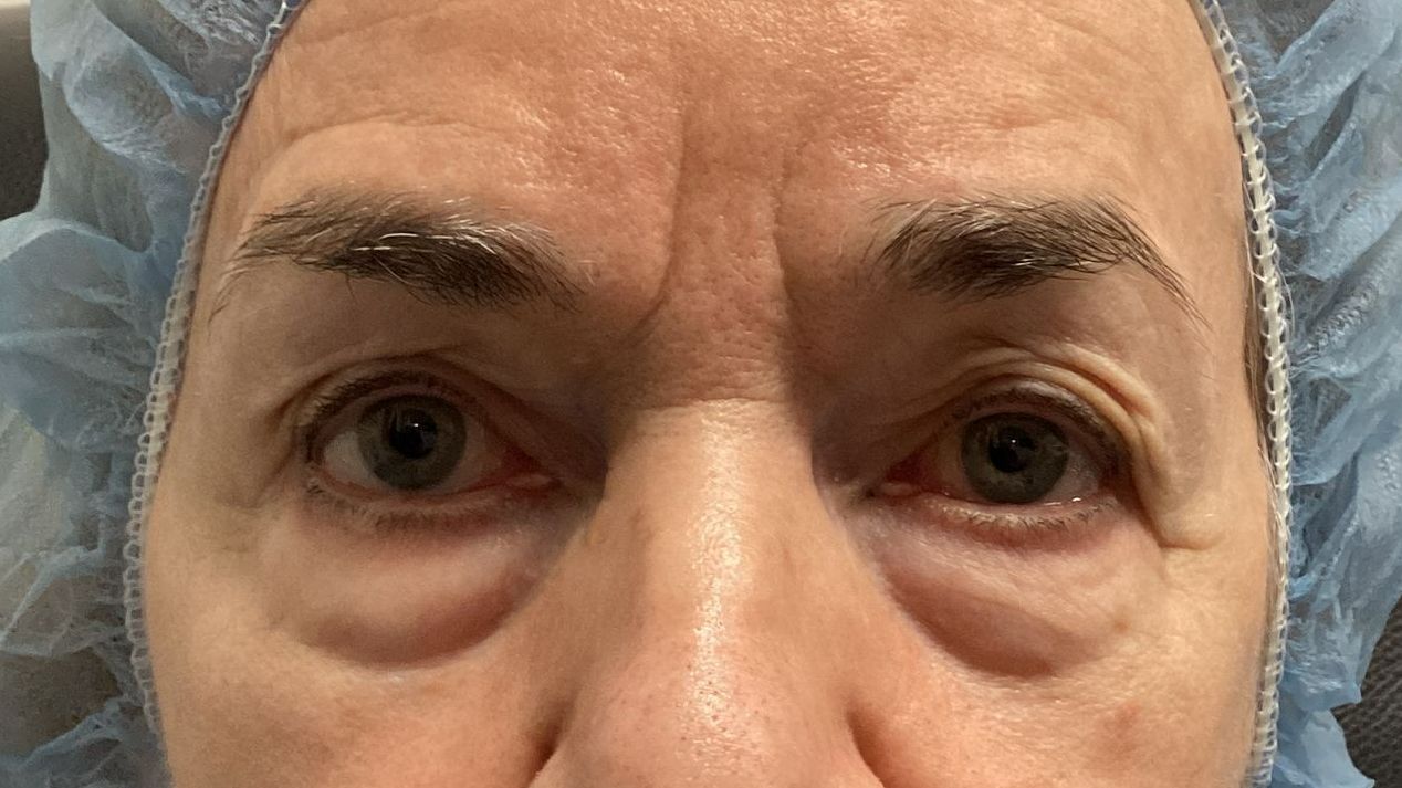 Chirurgie des 4 paupières