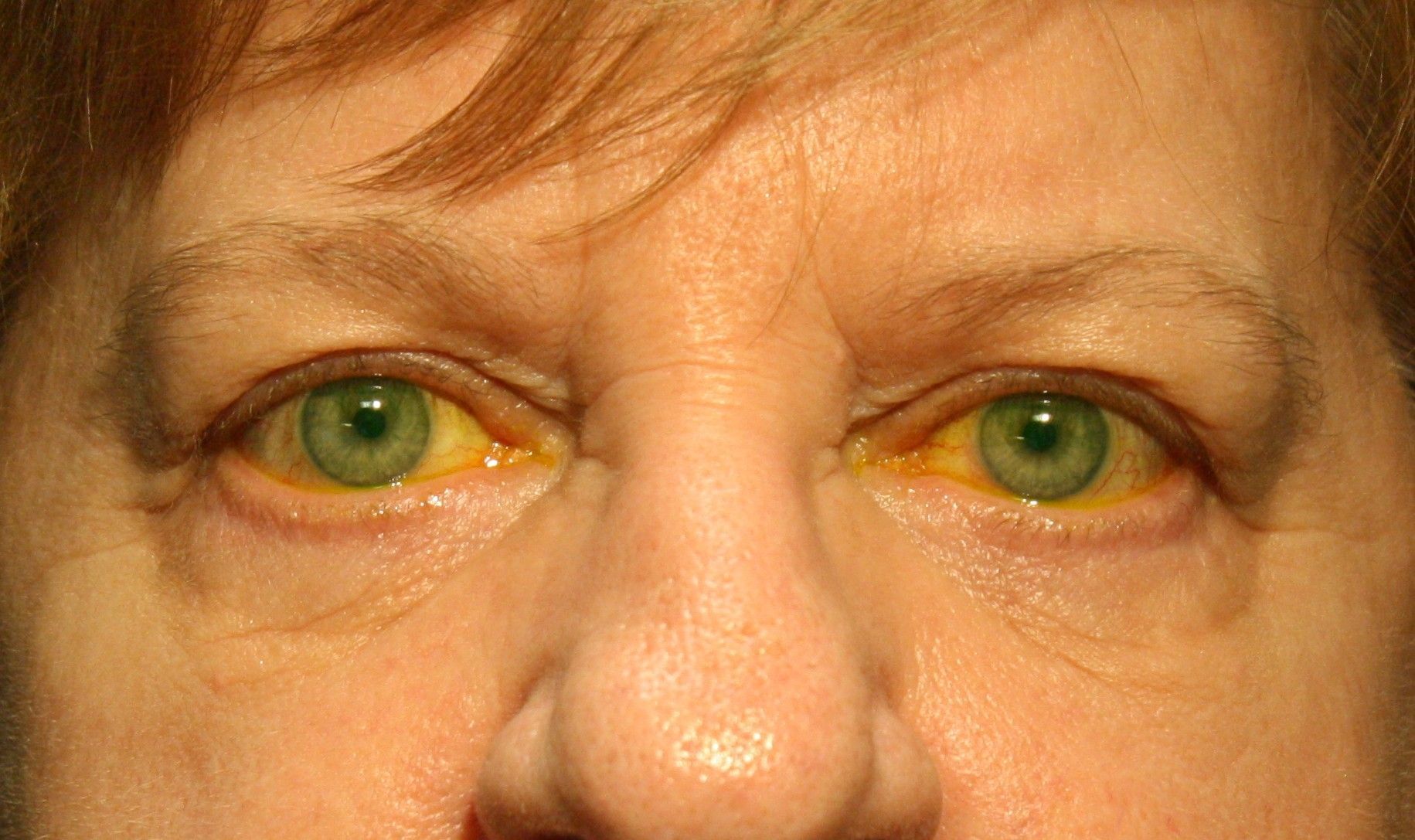 Chirurgie des paupieres inferieures