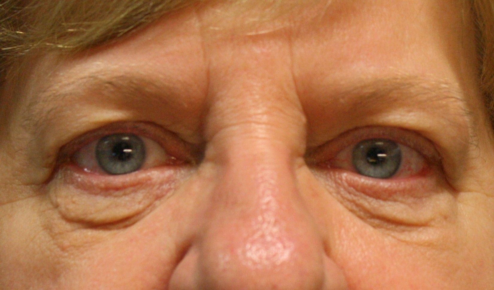 Chirurgie des paupieres inferieures