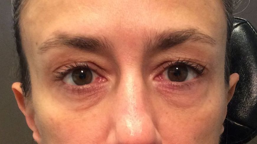 Chirurgie des paupieres inferieures