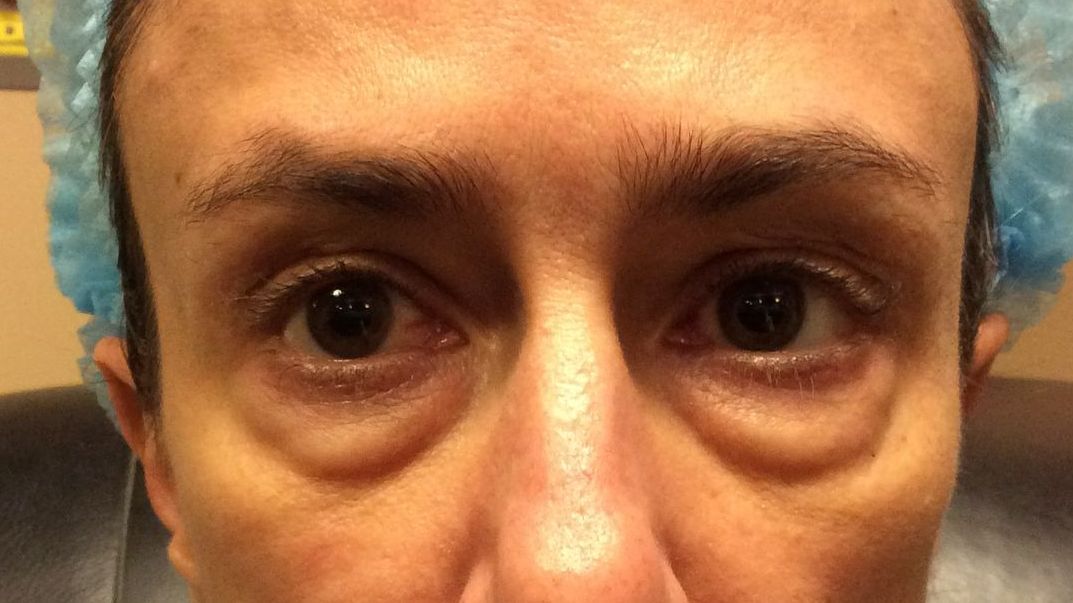 Chirurgie des paupieres inferieures