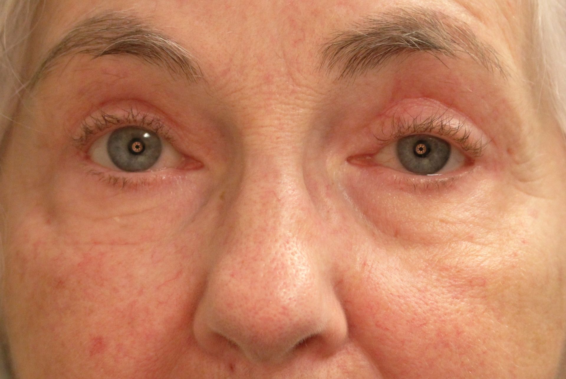 Chirurgie des paupières supérieures