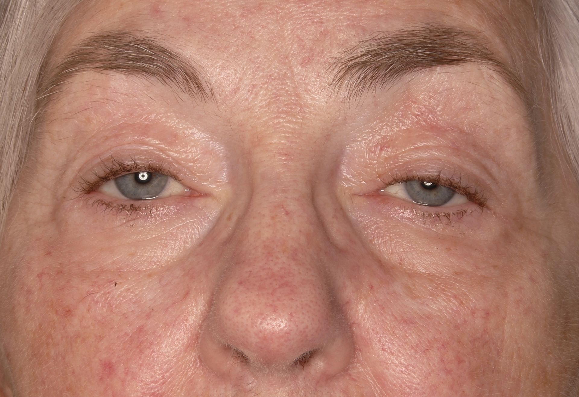 Chirurgie des paupières supérieures