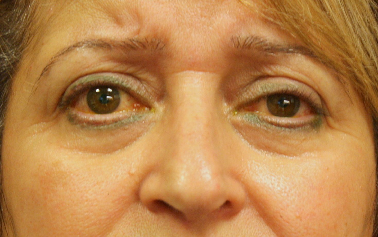 Correction de la ptose