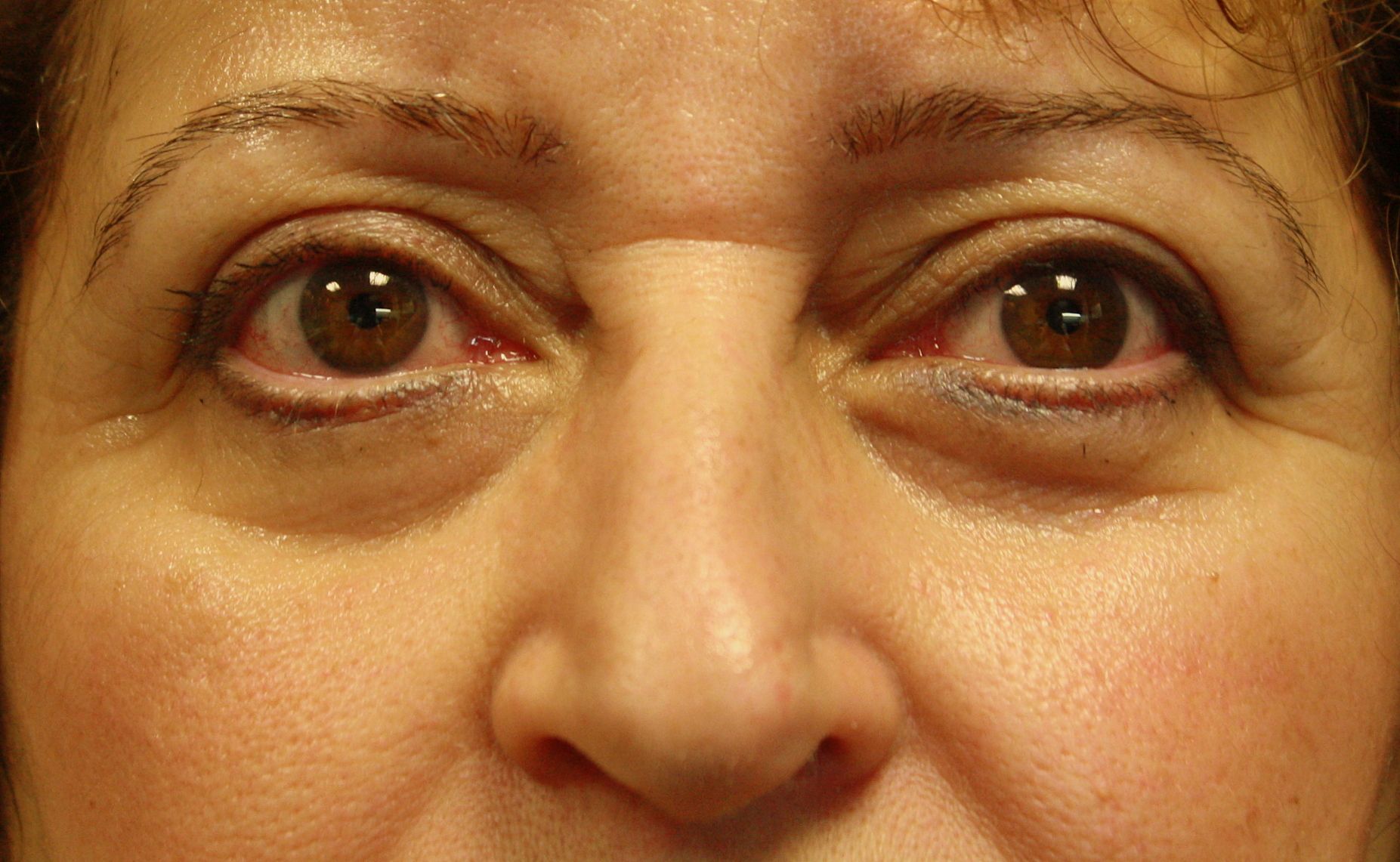 Correction de la ptose