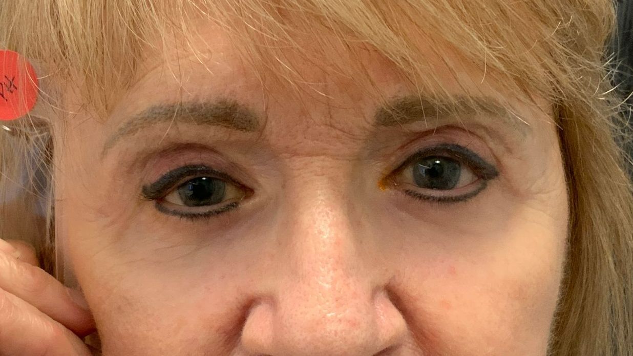 Chirurgie des 4 paupières