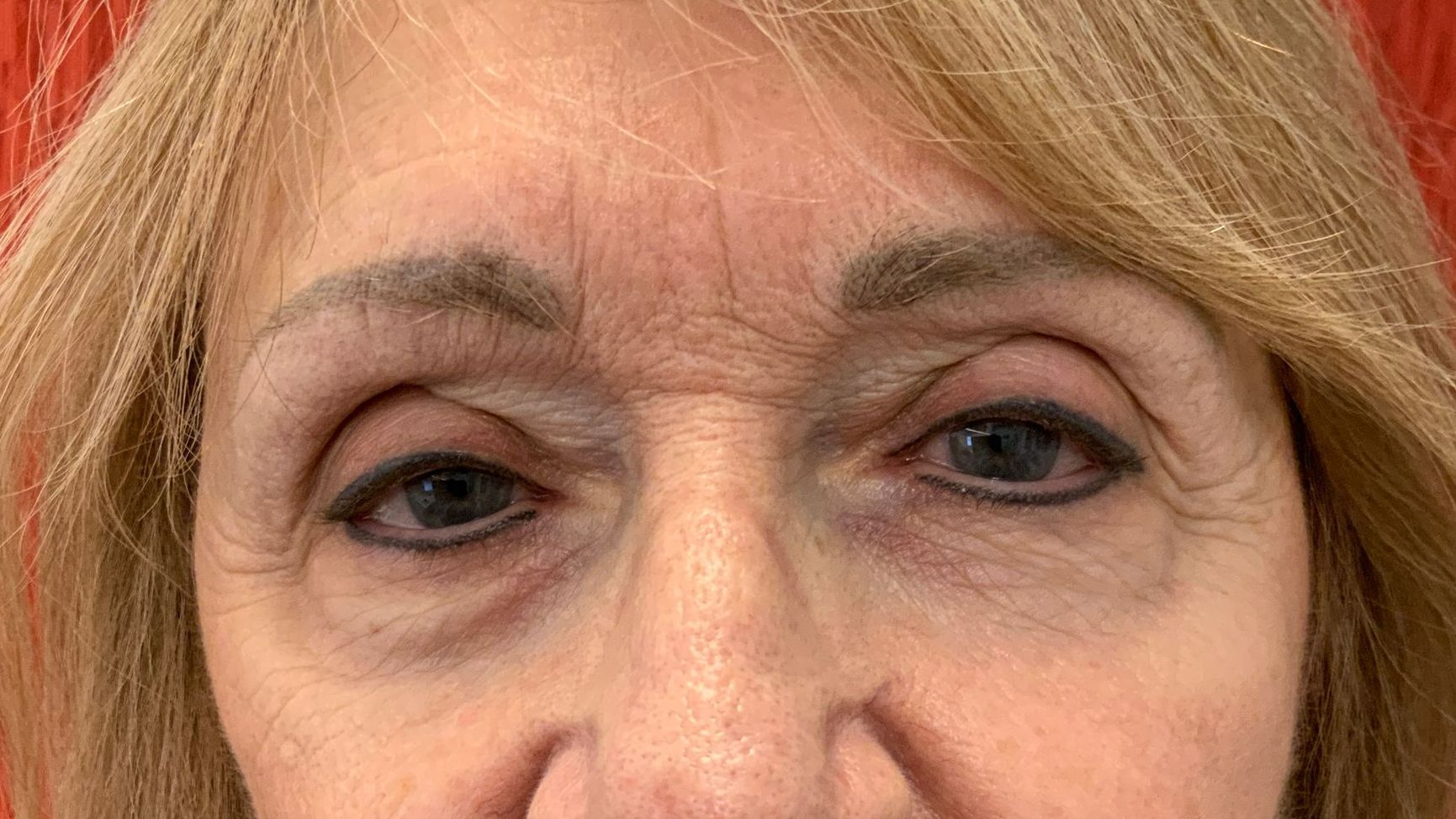 Chirurgie des 4 paupières