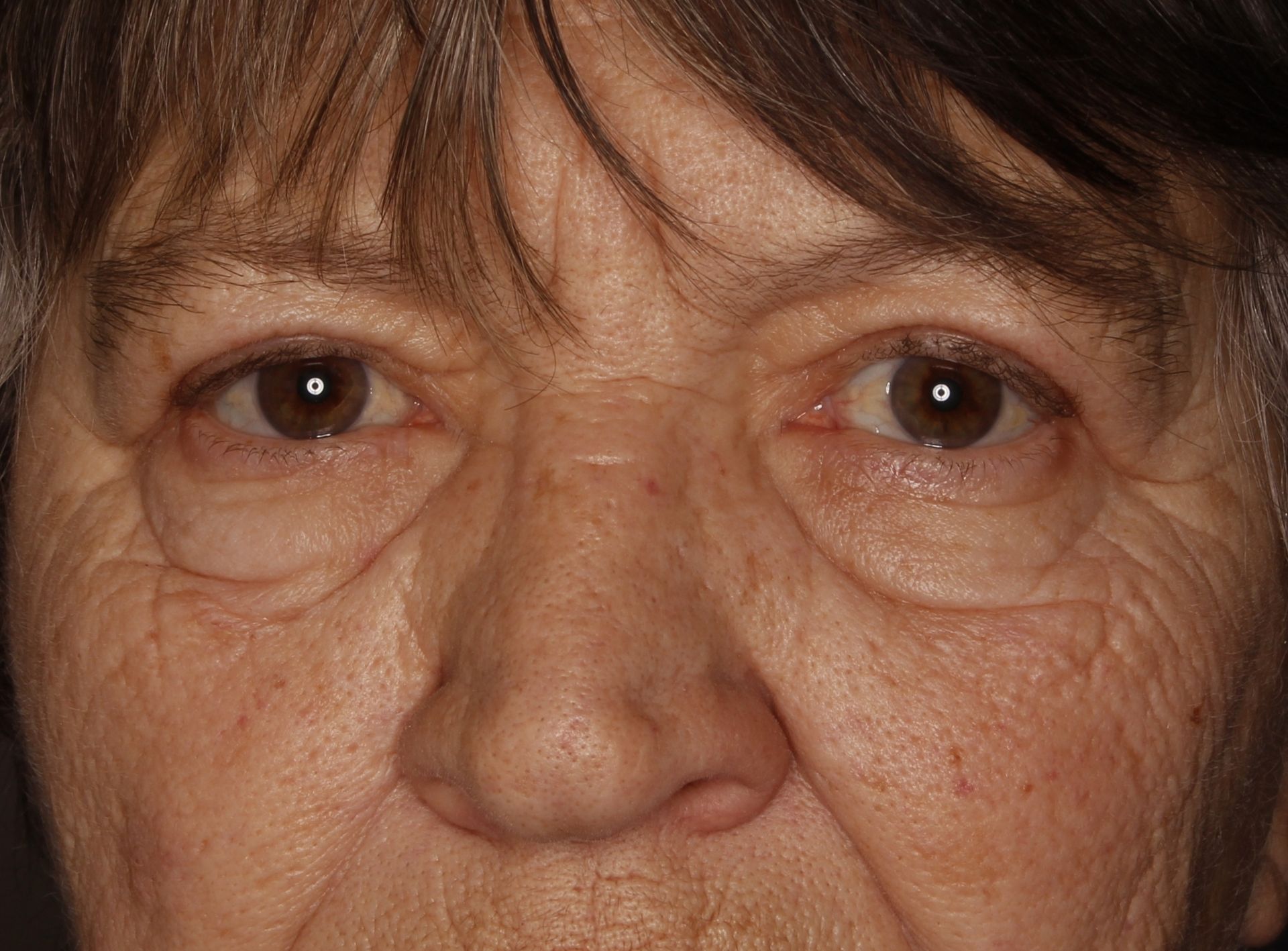 Chirurgie des paupières supérieures