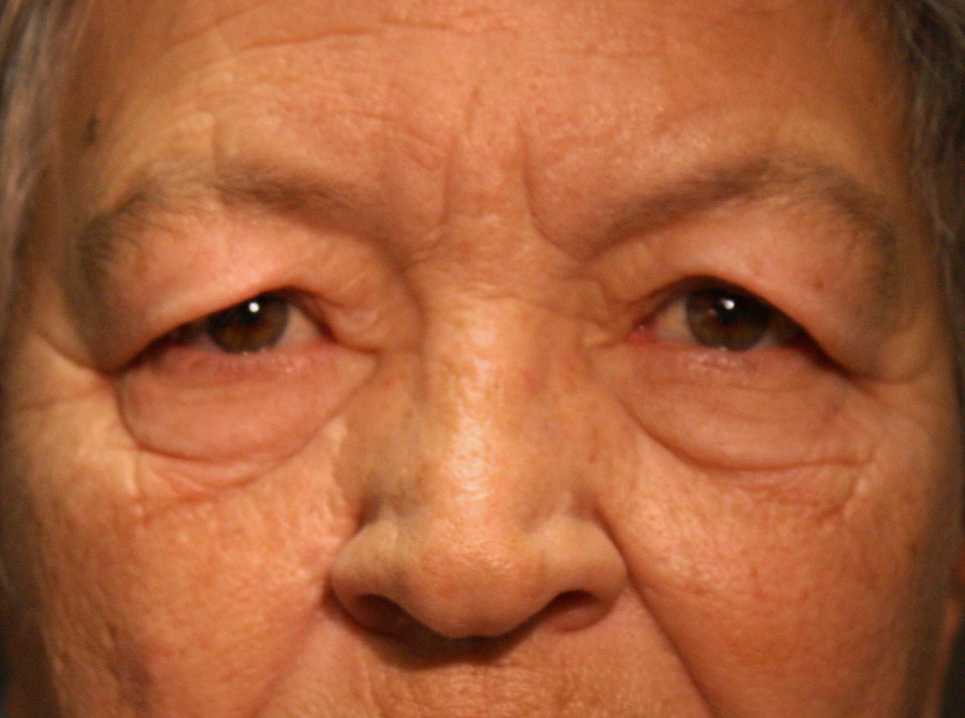 Chirurgie des paupières supérieures