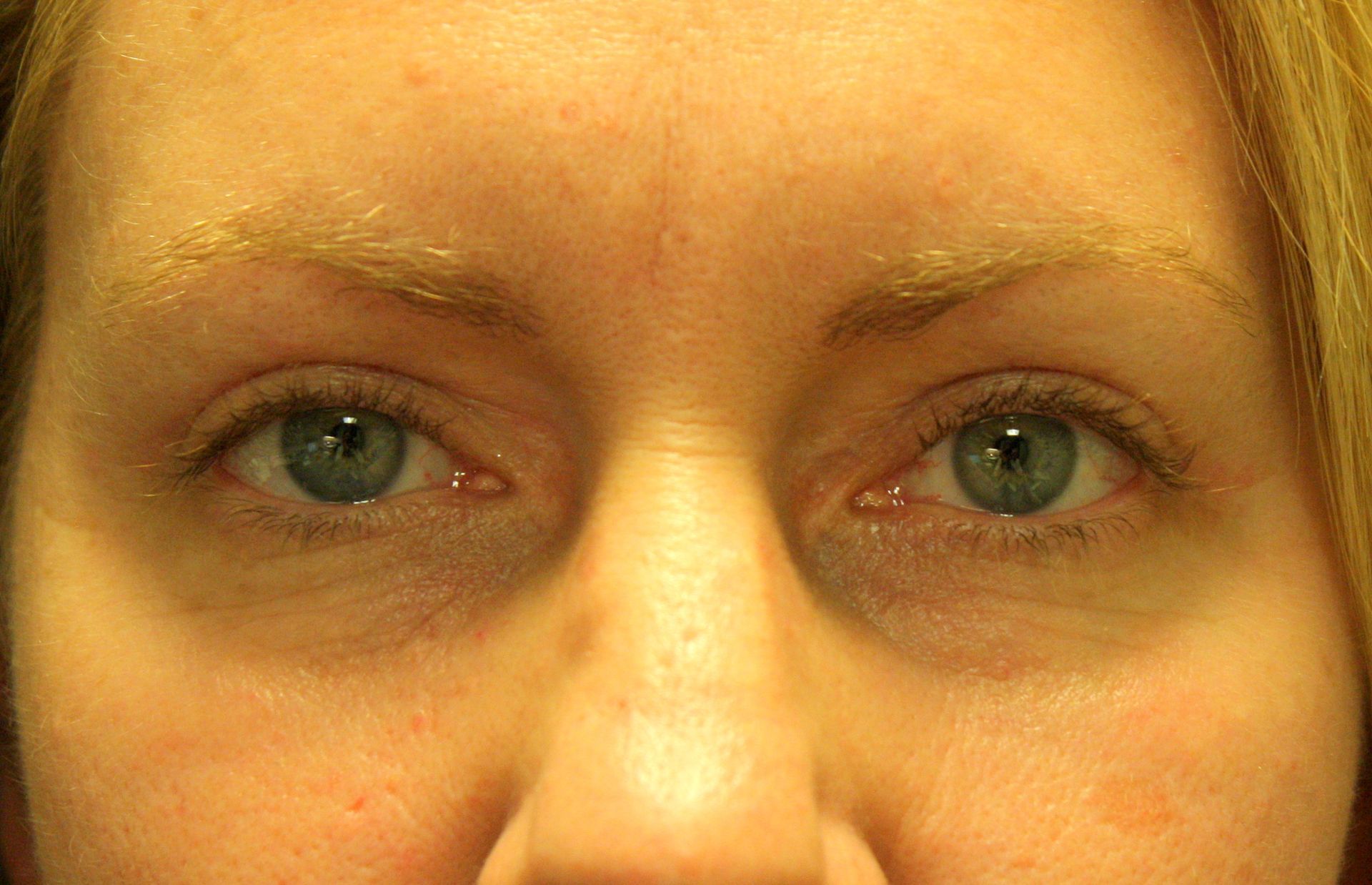 Chirurgie des paupières supérieures