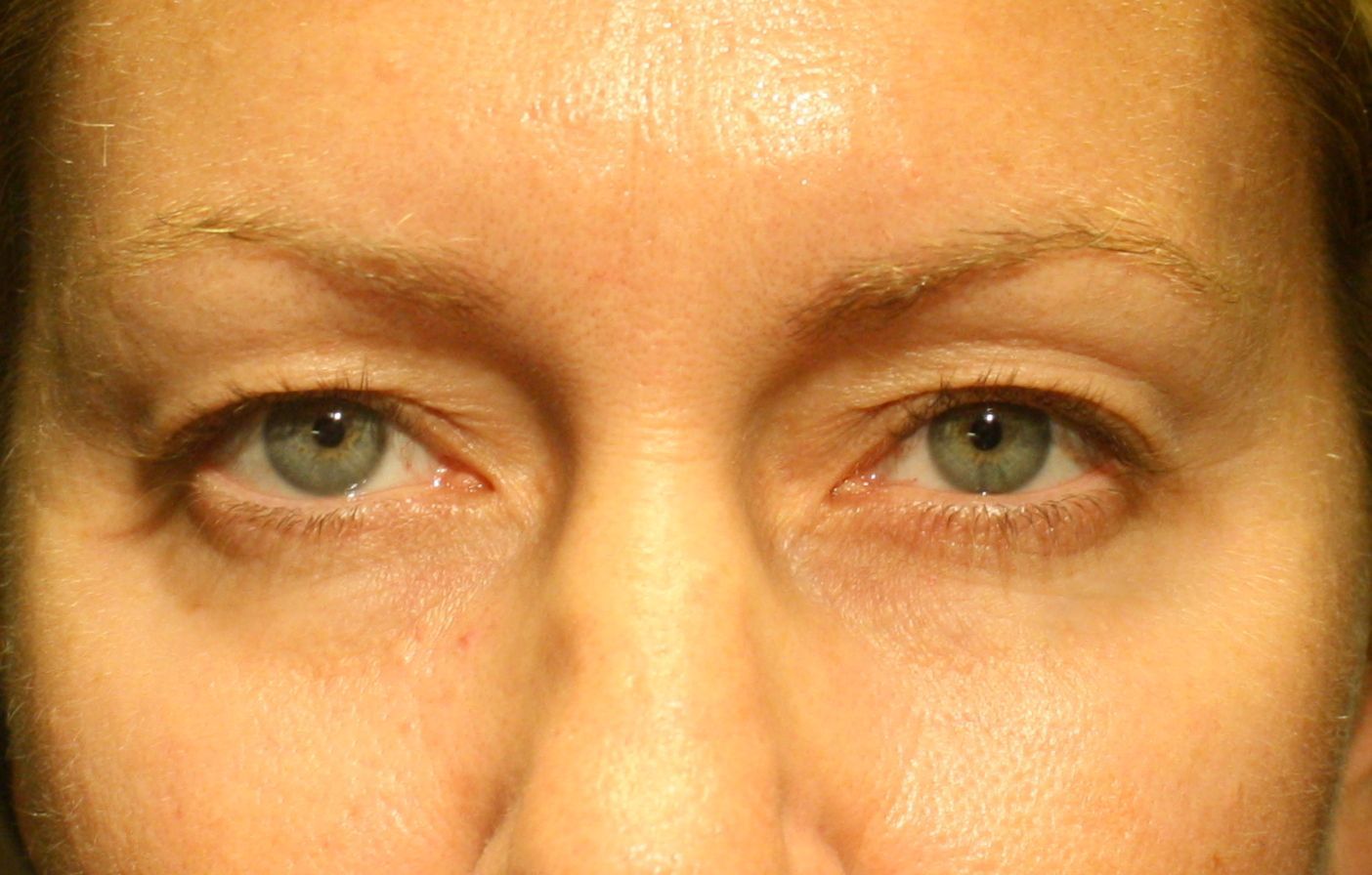 Chirurgie des paupières supérieures