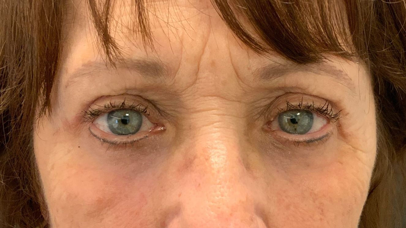 Chirurgie des 4 paupières