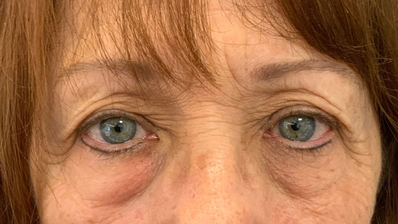 Chirurgie des 4 paupières