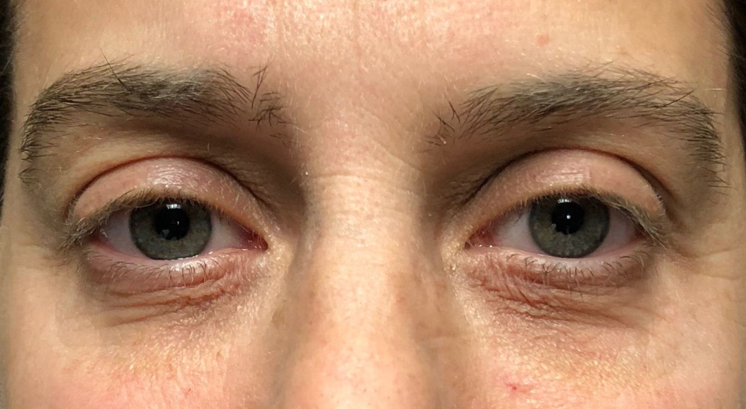 agent de comblement, yeux