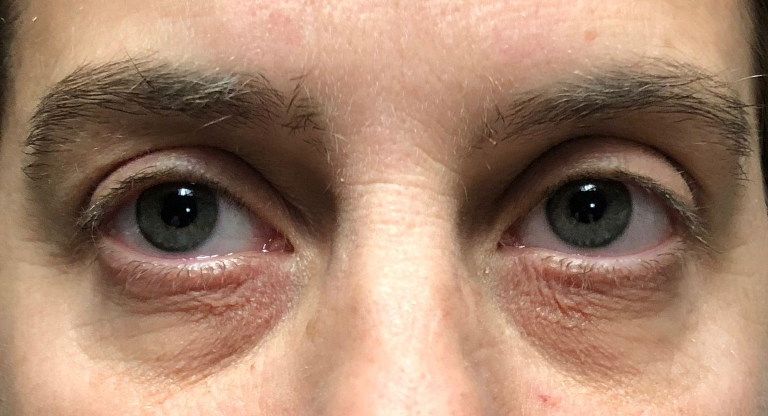 agent de comblement, yeux