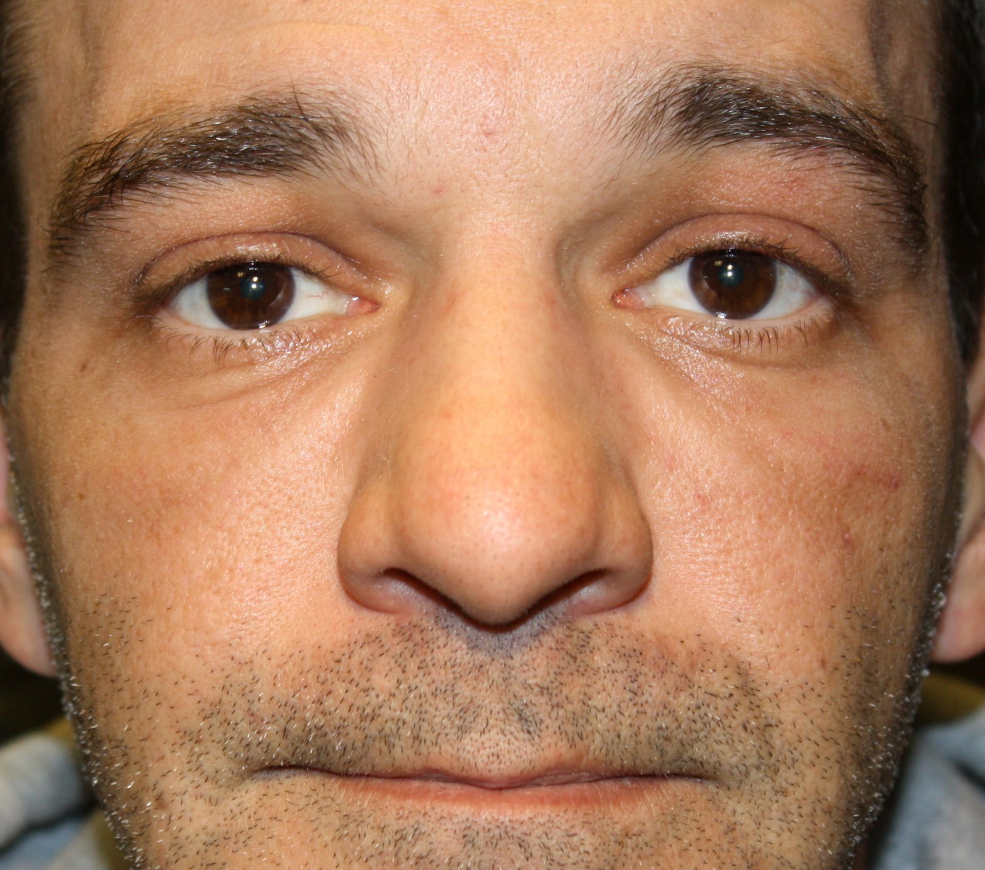 agent de comblement, yeux