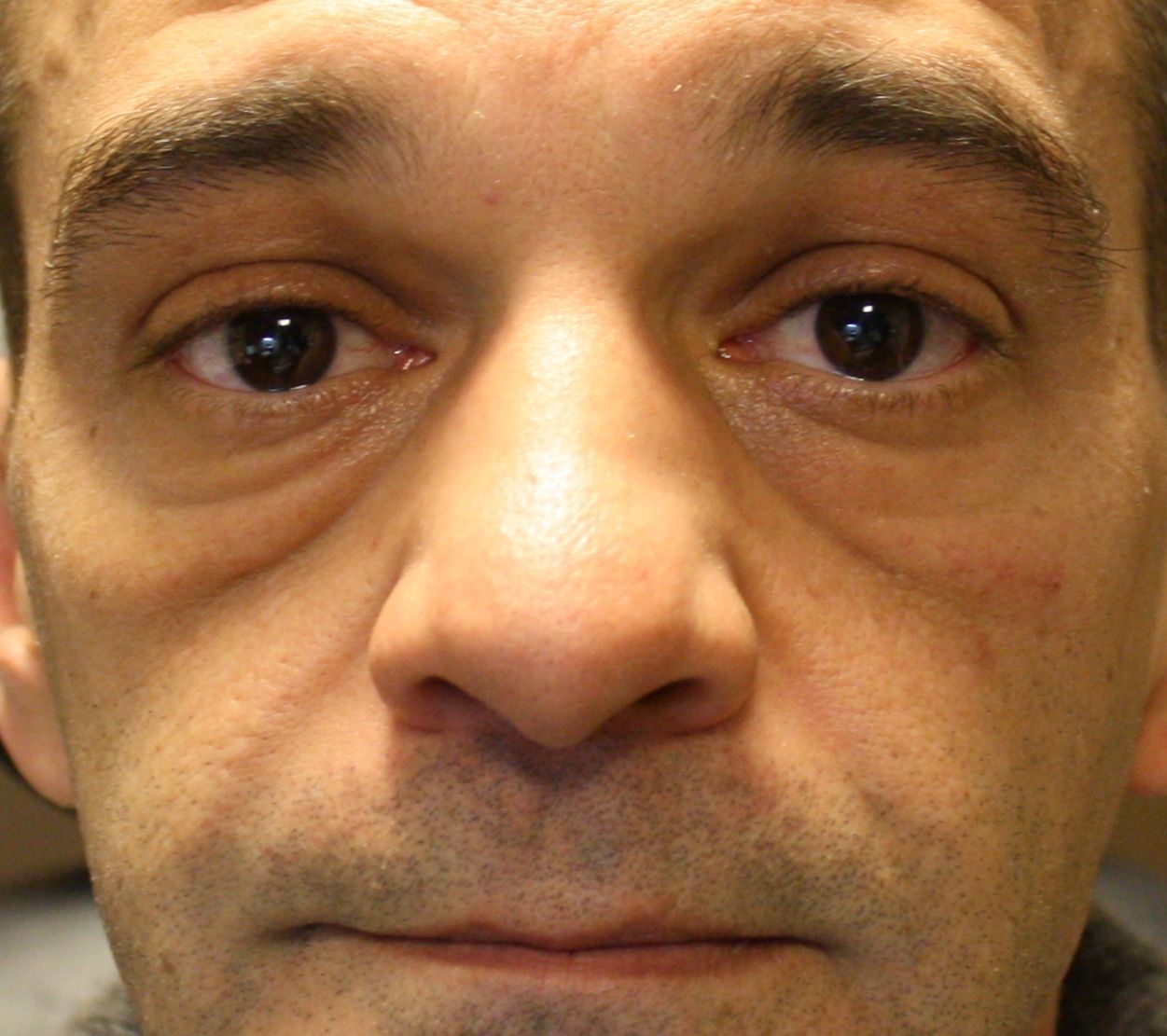 agent de comblement, yeux