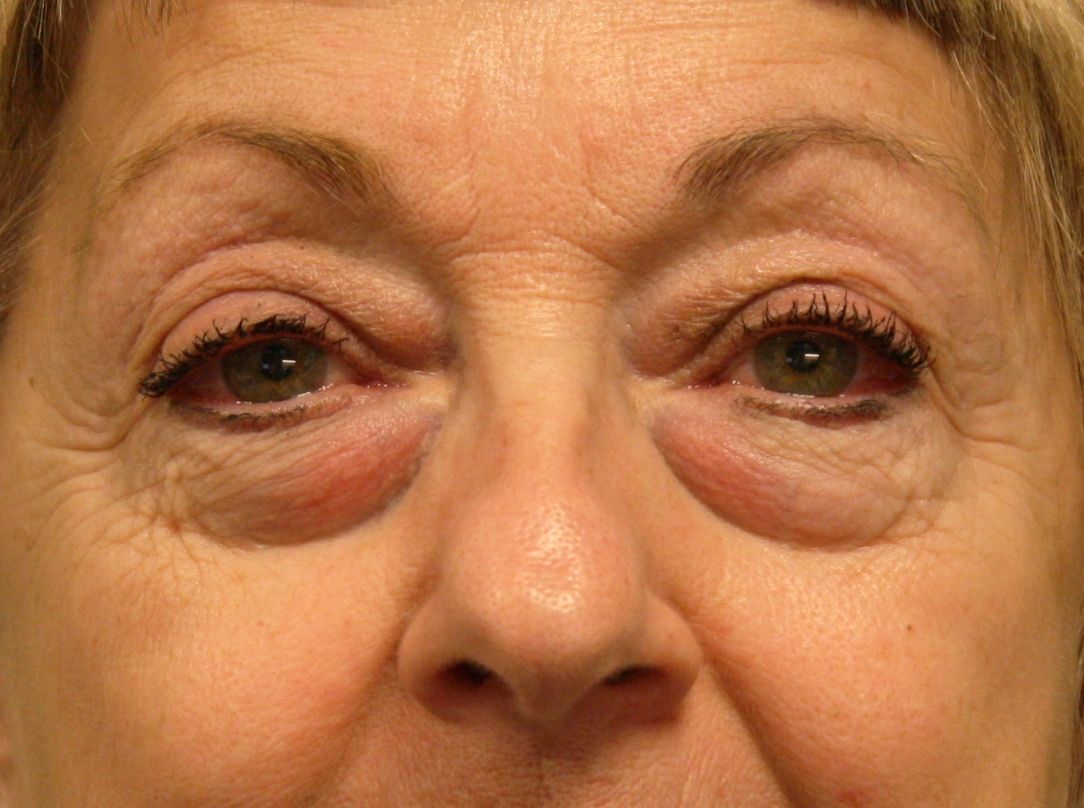 transposition de gras