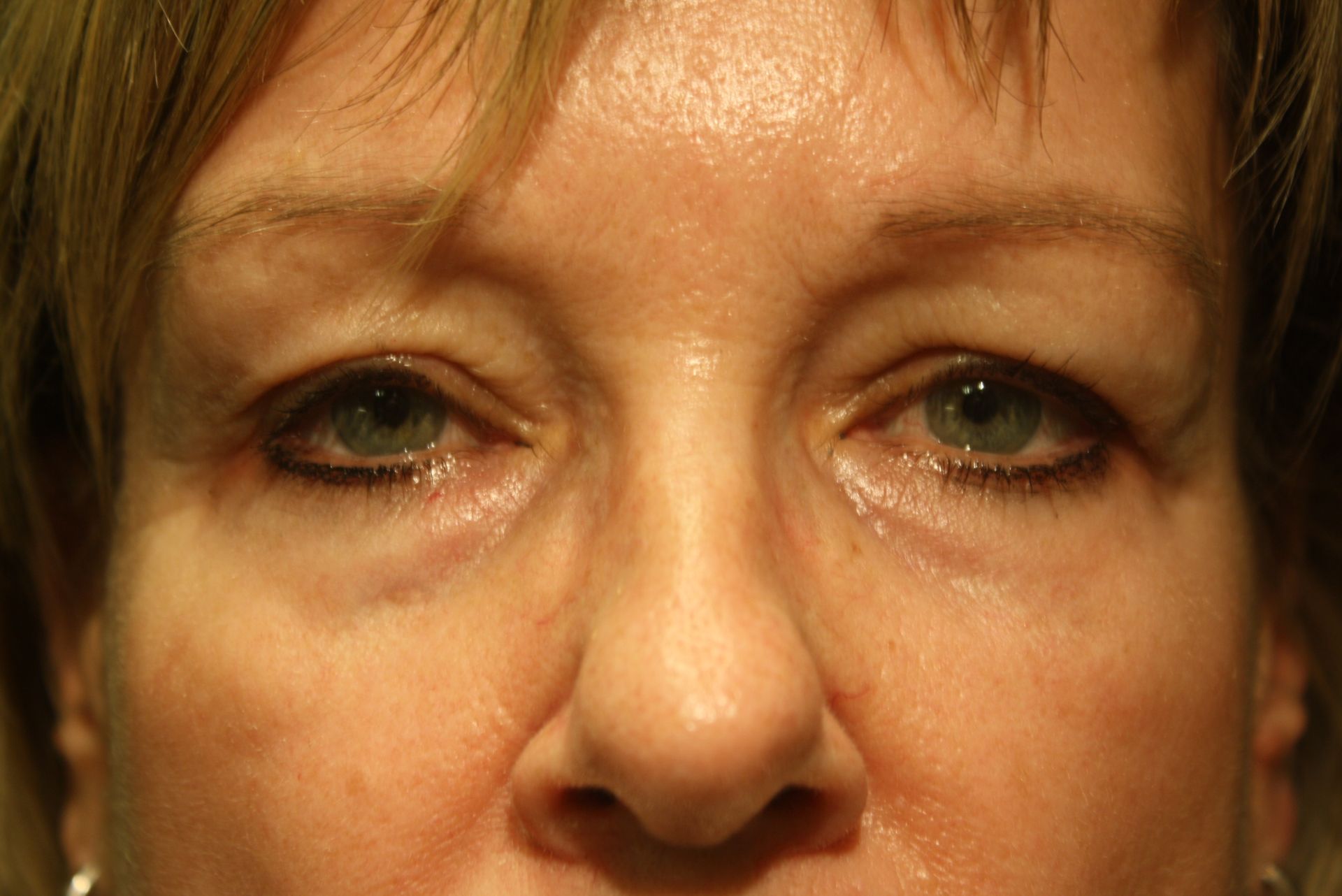 transposition de gras