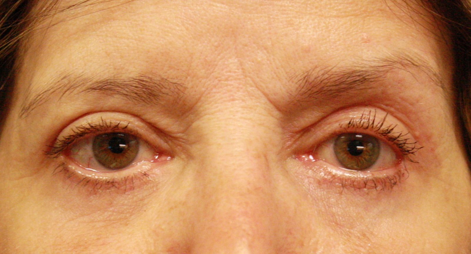 transposition de gras