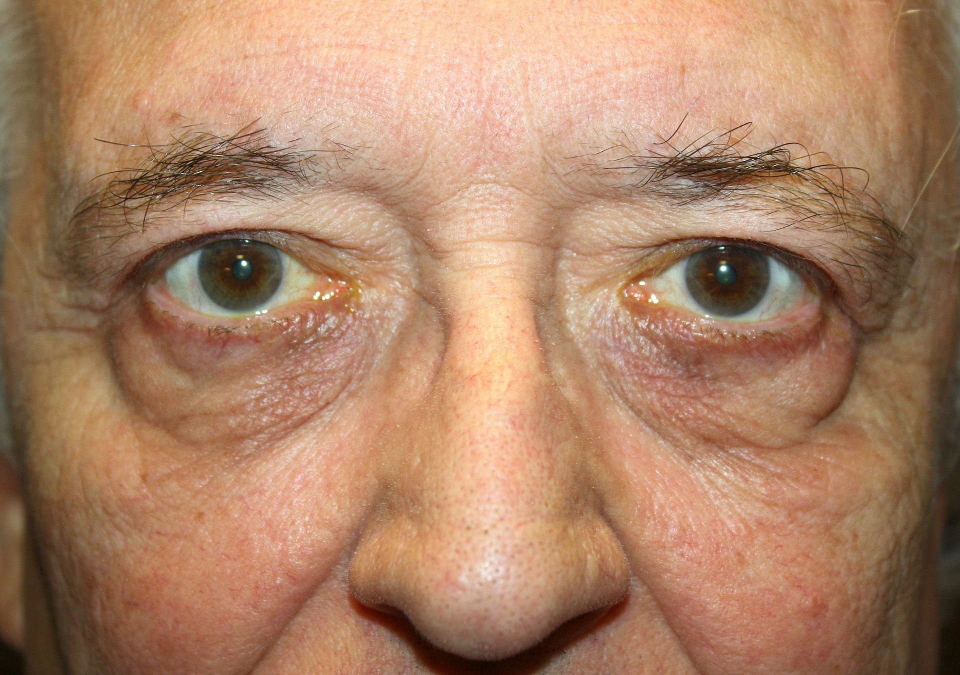 Chirurgie des paupières supérieures