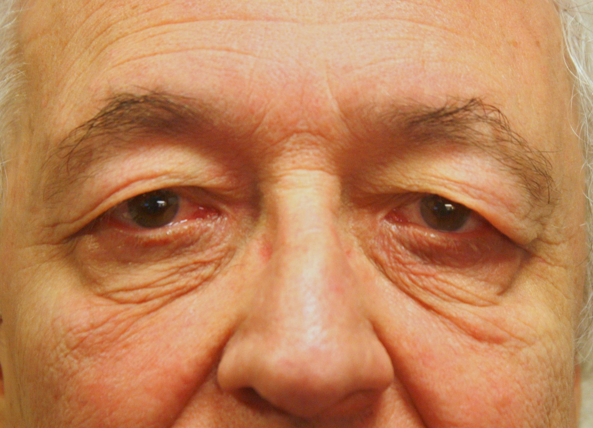 Chirurgie des paupières supérieures