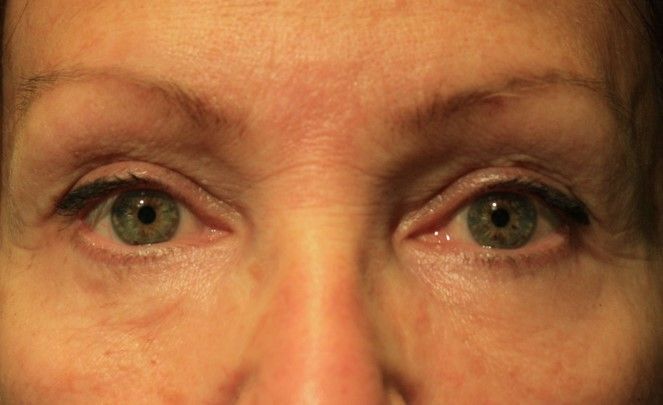 Chirurgie des paupieres inferieures