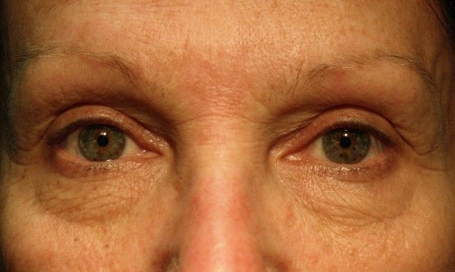 Chirurgie des paupieres inferieures
