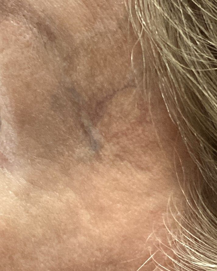 lesions vasculaires, veines-varices