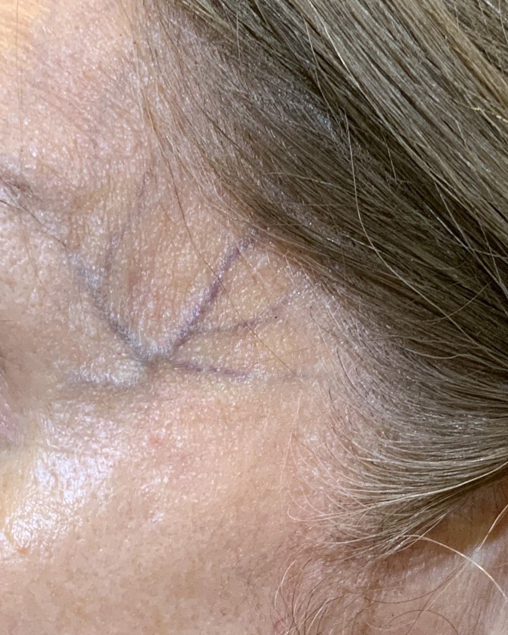 lesions vasculaires veines-varices