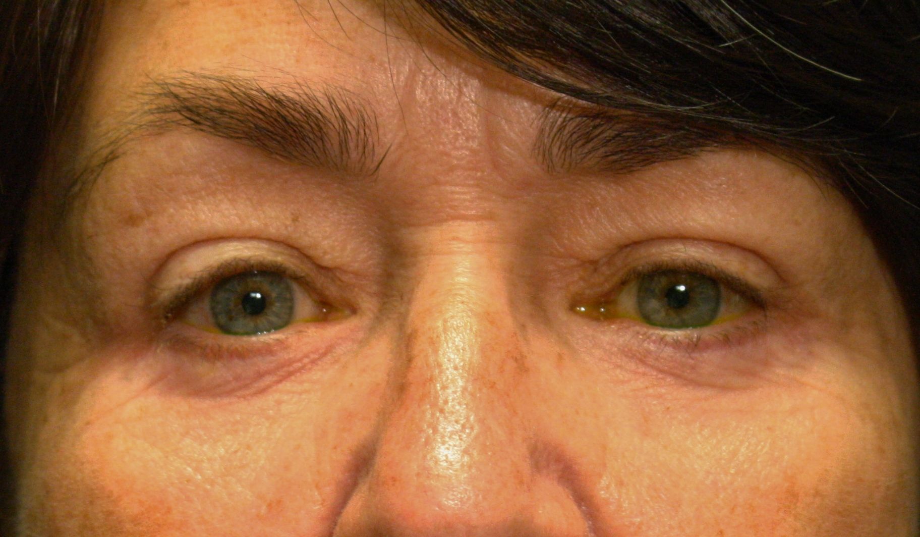 Chirurgie des 4 paupières